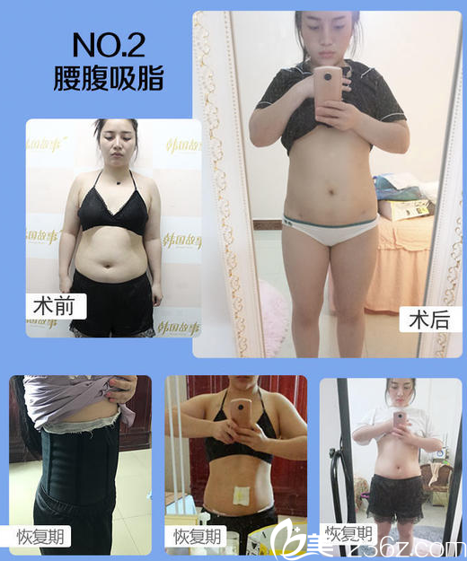 南寧韓成（韓國(guó)）故事整形醫(yī)院李寧腰腹吸脂案例