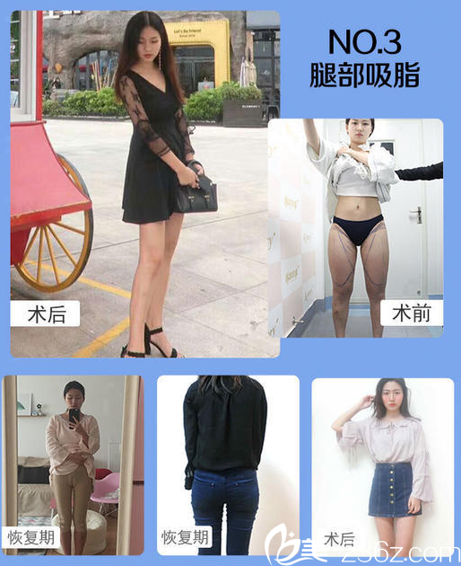 南寧韓成（韓國(guó)）故事整形醫(yī)院李寧大腿抽脂案例