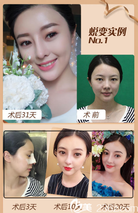 南寧韓成（韓國(guó)）故事整形醫(yī)院李寧鼻綜合隆鼻案例