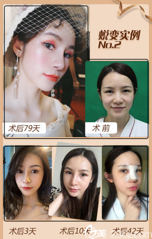 南寧韓成(韓國)故事醫(yī)療整形美容醫(yī)院高靜隆鼻案例對(duì)比圖 南寧韓成(韓國)故事醫(yī)療整形美容醫(yī)院高靜隆鼻案例對(duì)比圖