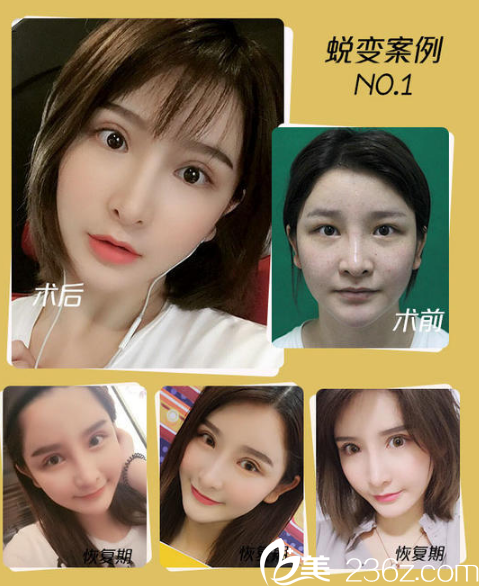 南寧韓成(韓國)故事醫(yī)療整形美容醫(yī)院高靜做的雙眼皮案例 南寧韓成(韓國)故事醫(yī)療整形美容醫(yī)院高靜做的雙眼皮案例