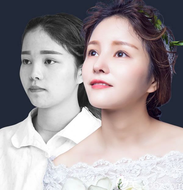 義烏歐萊美醫(yī)生打造美鼻范 肋軟骨綜合隆鼻手術(shù)案例