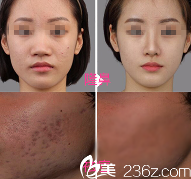 重慶美侖美奐整形姬廣翰真人案例 重慶美侖美奐整形姬廣翰真人案例