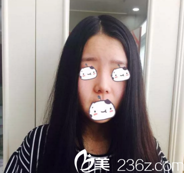 重慶美侖美奐整形施問國院長綜合隆鼻術(shù)前 重慶美侖美奐整形施問國院長綜合隆鼻術(shù)前