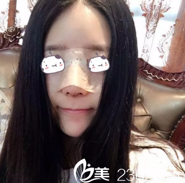 鼻綜合案例術(shù)后1周重慶美侖美奐 鼻綜合案例術(shù)后1周重慶美侖美奐
