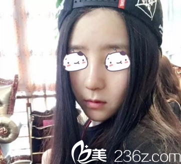 術(shù)后15天效果圖鼻綜合案例重慶美侖美奐 術(shù)后15天效果圖鼻綜合案例重慶美侖美奐