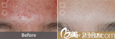 美爾韓祛除青春痘<span style=