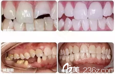 重慶美侖美奐整形馬超群醫(yī)生美容冠案例 重慶美侖美奐整形馬超群醫(yī)生美容冠案例