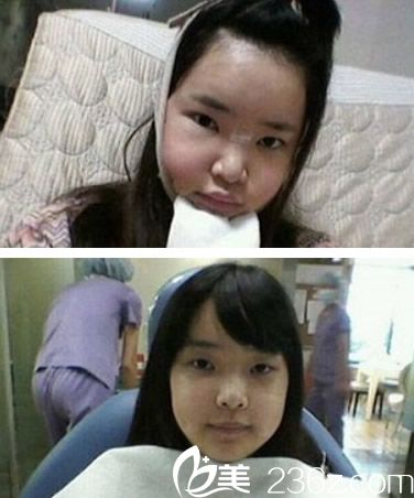 歐菲自體脂肪填充術(shù)前準備 歐菲自體脂肪填充術(shù)前準備