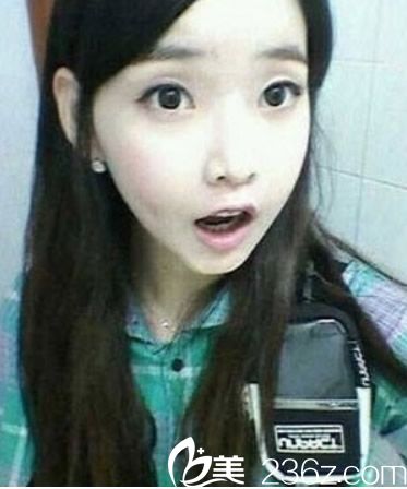 我在泉州歐菲找王偉韜做自體脂肪填充下巴效果好嗎？