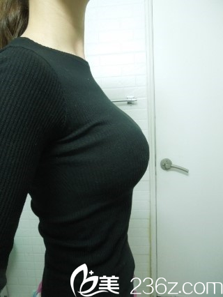 我做假體隆胸的完美蛻變 我做假體隆胸的完美蛻變