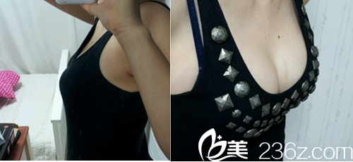 西安高一生醫(yī)療美容醫(yī)院<!--<i data=20240703-sp></i>-->醫(yī)生做假體隆胸效果 西安高一生醫(yī)療美容醫(yī)院<!--<i data=20240703-sp></i>-->醫(yī)生做假體隆胸效果