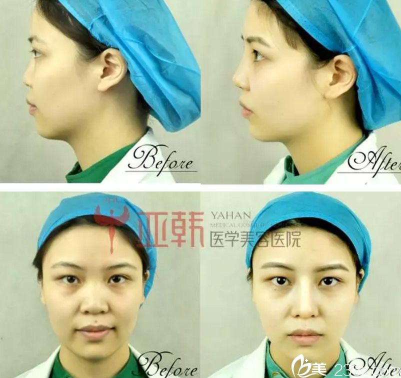 長沙鼻整形醫(yī)生吳蒙真人案例 長沙鼻整形醫(yī)生吳蒙真人案例