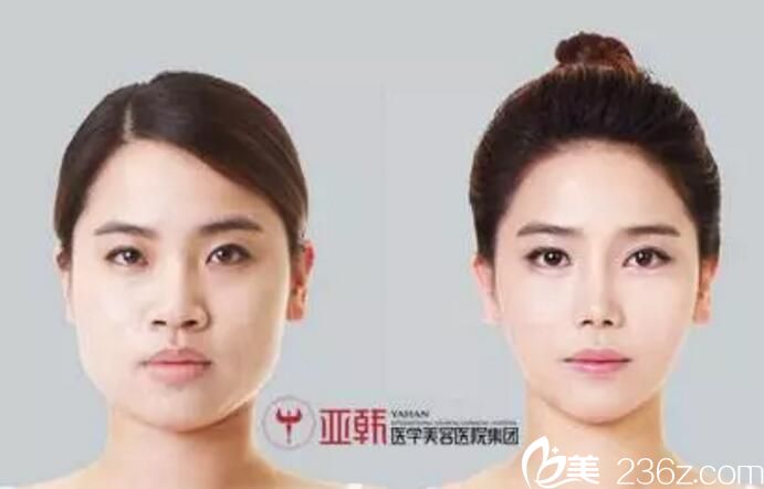 長沙亞韓趙貴慶打造的案例 隆鼻雙眼皮