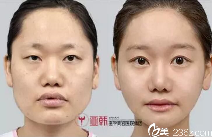 長沙亞韓趙貴慶雙眼皮真人案例