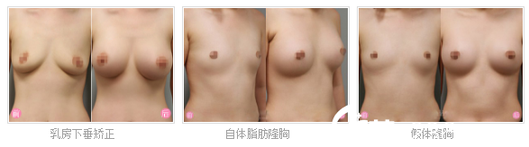 廣州曙光<!--<i data=20240703-sp></i>-->隆胸<span style=