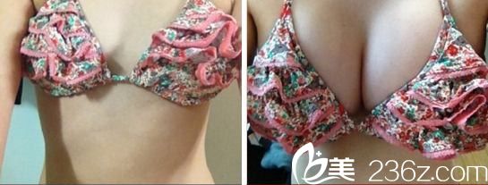 韓國嫵麗整形外科醫(yī)院姜民赫院長隆胸怎么樣？