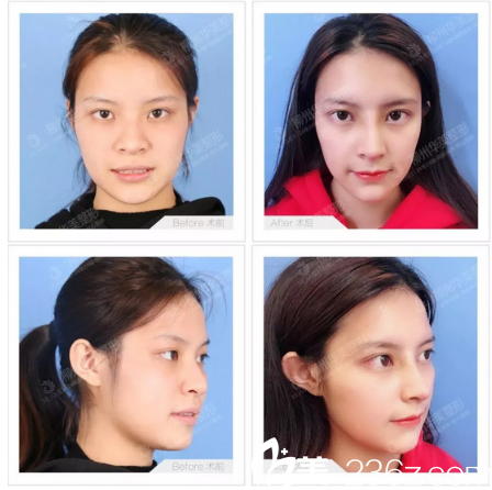 柳州華美王文肋軟骨隆鼻案例 柳州華美王文肋軟骨隆鼻案例