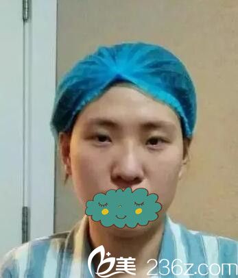 眼綜合加鼻綜合術(shù)前 眼綜合加鼻綜合術(shù)前