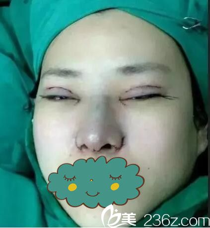 海南夢(mèng)妮幻眼鼻整形術(shù)后即刻 海南夢(mèng)妮幻眼鼻整形術(shù)后即刻