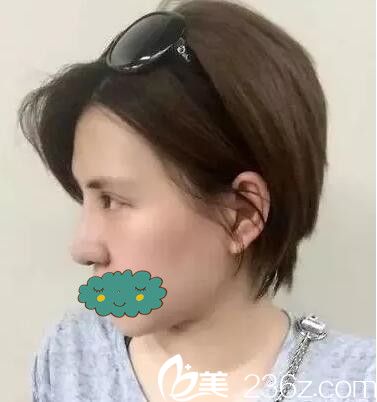 術(shù)后一周眼鼻整形拆線(xiàn)側(cè)顏效果 術(shù)后一周眼鼻整形拆線(xiàn)側(cè)顏效果