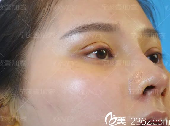 做完鼻綜合7天拆線的<span style=