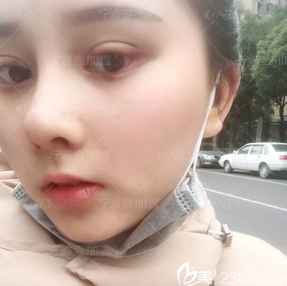 寧波壹加壹護(hù)士做雙眼皮和隆鼻15天<span style=