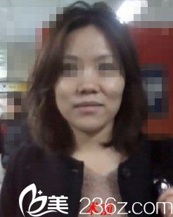 韓國431整形外科金載勛院長隆鼻怎么樣？真人案例