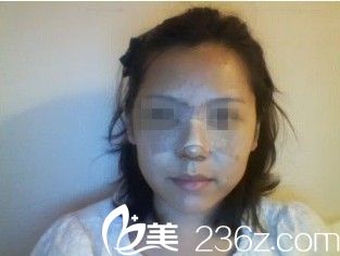 金載勛院長隆鼻術(shù)后三天