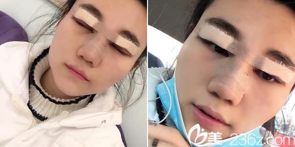 做完眼睛和鼻子手術(shù)當(dāng)天 做完眼睛和鼻子手術(shù)當(dāng)天