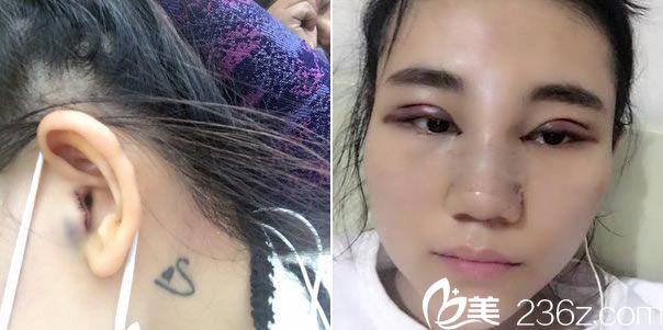 耳軟骨隆鼻手術(shù)第2天恢復(fù)照 耳軟骨隆鼻手術(shù)第2天恢復(fù)照