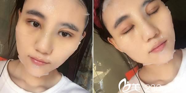 做雙眼皮手術(shù)第9天敷面膜照片 做雙眼皮手術(shù)第9天敷面膜照片