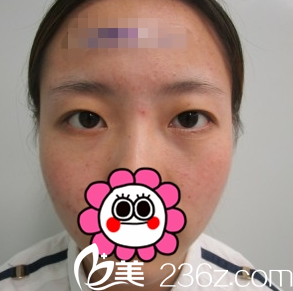 長(zhǎng)治悅美雙眼皮整形術(shù)前 長(zhǎng)治悅美雙眼皮整形術(shù)前