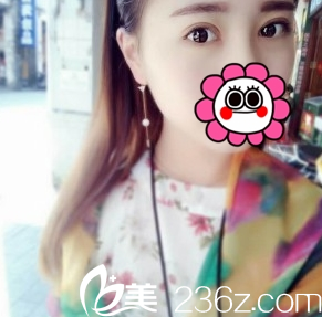 真人案例雙眼皮術(shù)后15天長(zhǎng)治悅美整形 真人案例雙眼皮術(shù)后15天長(zhǎng)治悅美整形