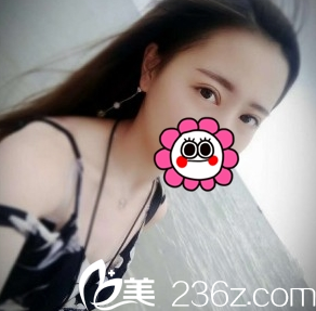 雙眼皮恢復(fù)日記組圖：長(zhǎng)治悅美整形1周讓我有無(wú)痕美眼效果