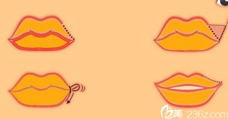 wrap-around corner lift 嘴角上揚 wrap-around corner lift 嘴角上揚