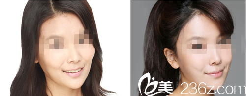 樸英進院長童顏術前后對比 樸英進院長童顏術前后對比