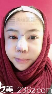 韓國美迪瑩整形真人案例3