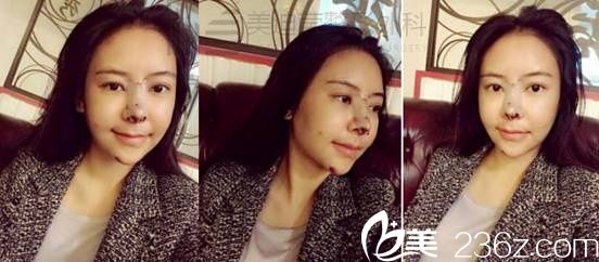 韓國美迪瑩整形真人案例4