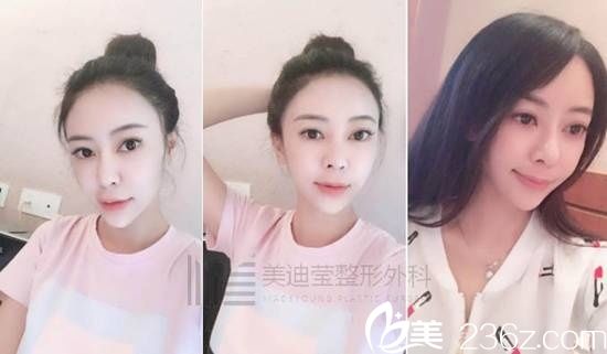 韓國美迪瑩整形真人案例6