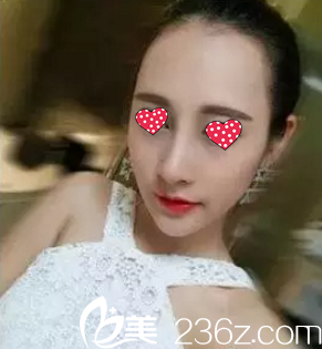 做完修復(fù)15天鼻子恢復(fù)中