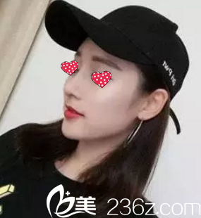 術(shù)后1個(gè)月鼻子恢復(fù)自然