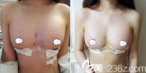 韓國高蘭得假體隆胸術(shù)后一天