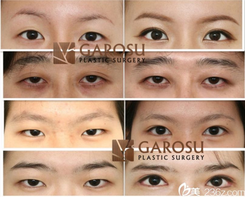 樸章佑做眼部整的精彩案例 樸章佑做眼部整的精彩案例