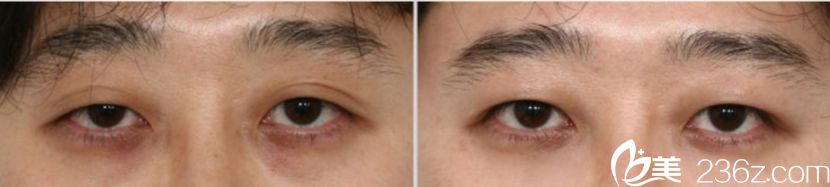 韓國凱倫秀整形醫(yī)院術(shù)前照片1