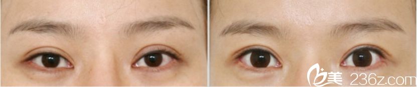 韓國凱倫秀整形外科非切開雙眼皮真人案例