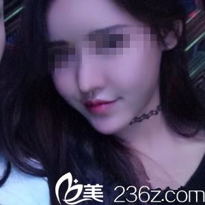 韓國眼鼻美人整形崔鐘武院長隆鼻好不好？膨體隆鼻真人案例