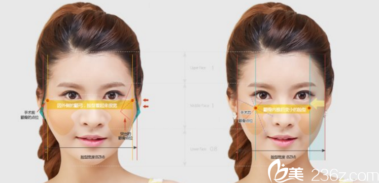 鄭宰永院長(zhǎng)顴骨手術(shù)-后端顴骨縮小術(shù) 鄭宰永院長(zhǎng)顴骨手術(shù)-后端顴骨縮小術(shù)