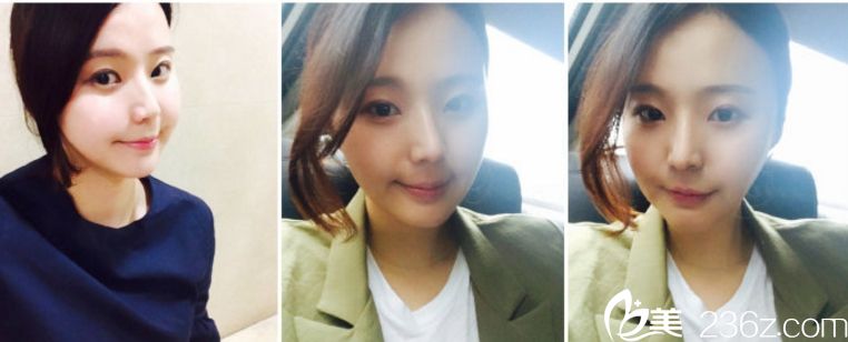 找韓國拉菲安鄭宰永院長做的顴骨縮小+vline 讓我變得美麗自信