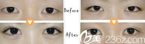 段春巍醫(yī)生雙眼皮案例